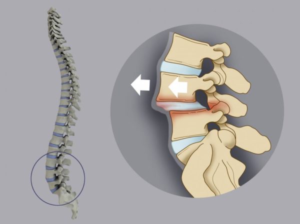 Занятия лечебной физкультурой показаны при появлении болей в спине